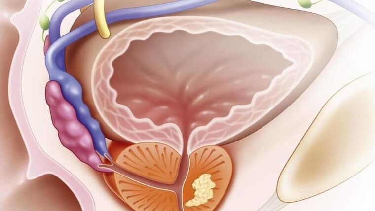 Chronische prostatitis